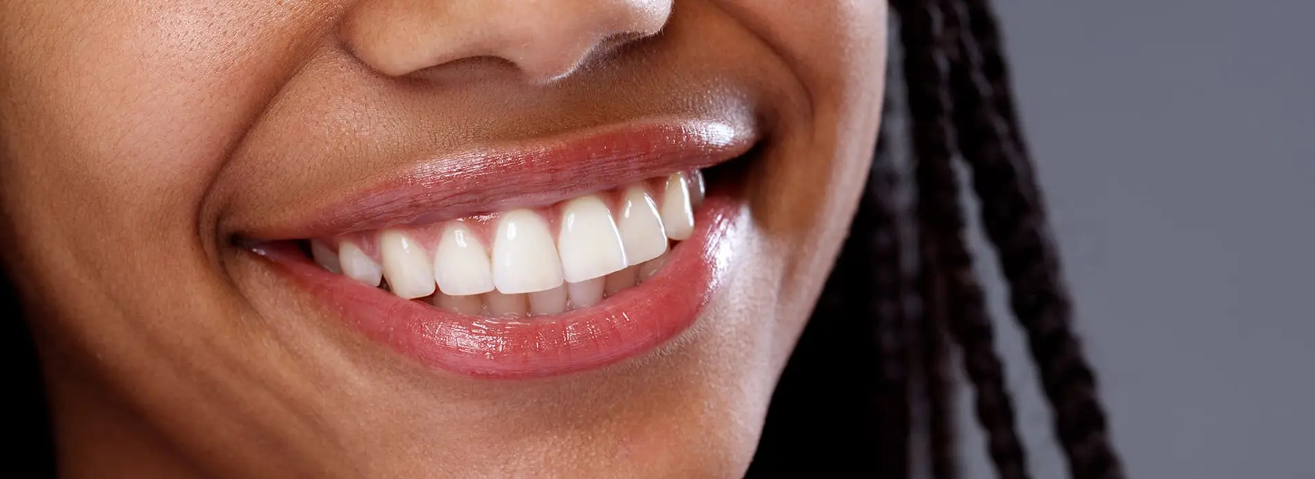 How to Keep Your Smile Bright After Professional Whitening