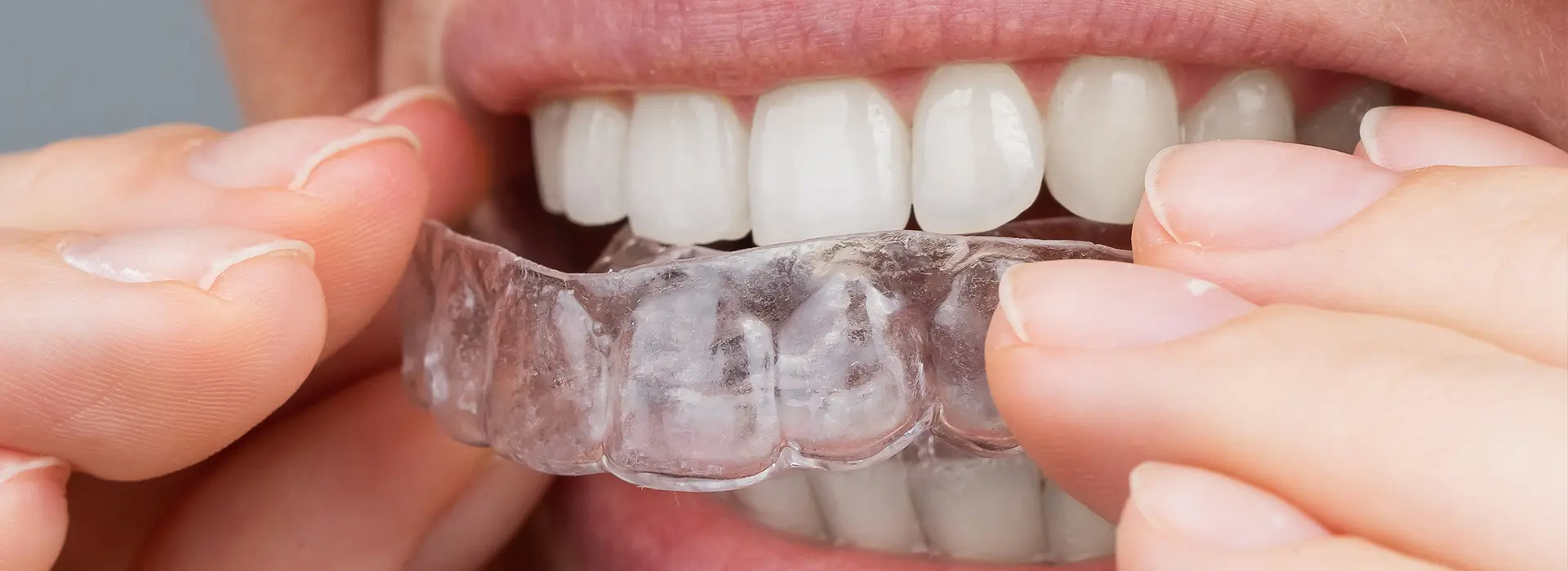 From Awkward to Awesome: Adjusting to Your New Dental Appliance
