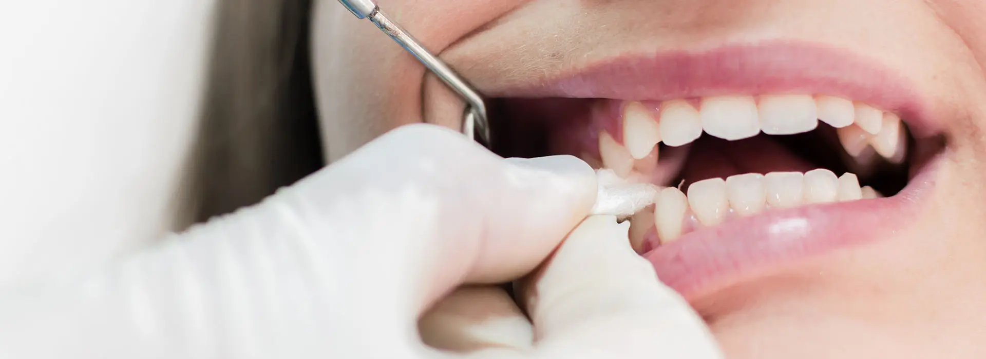 How Long to Keep Gauze in After Tooth Extraction