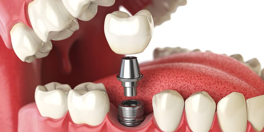 Dental Implants and Bone Grafts