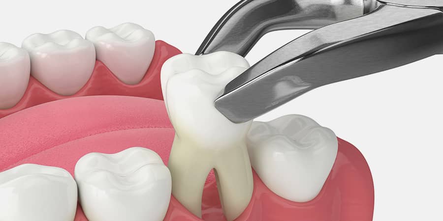 Tooth Extraction In Greeley CO Clearwater Dentistry