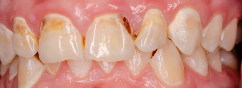 How To Prevent Tooth Decay & Gum Disease