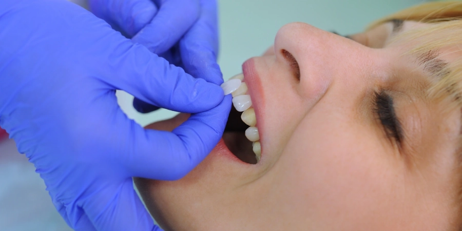 Dental Veneers at Clearwater Dentistry Greeley CO
